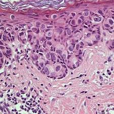 What it is, common symptoms, getting diagnosed, and treatment options. Histological Examination Of Page S Disease Paget S Cells With Download Scientific Diagram