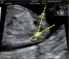 Full Text Ultrasound Measurement Learning Of Fetal Sex
