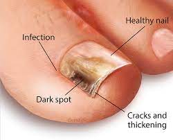 are your nails healthy dermatology