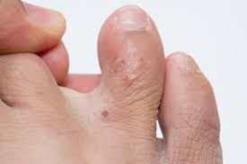 Many of these conditions on the hands or feet are itchy, but, in some people, they may not itch at all. Types Of Eczema Dyshidrotic Eczema National Eczema Association