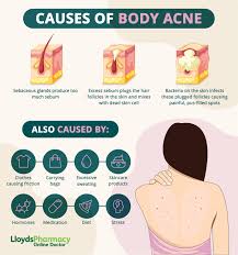 chest and back acne lloydspharmacy