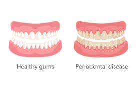 learn how to prevent and treat gum