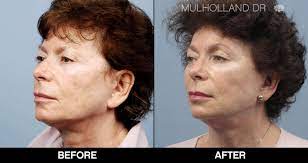 Neck lifts costs | prices: Toronto Mini Facelift Clinic Toronto Spamedica