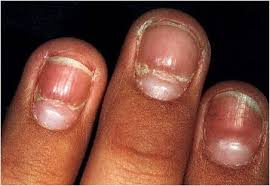 nail diseases and disorders flashcards