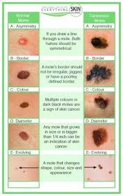 Melanoma, the most serious form of skin cancer, is diagnosed in about 77,000 people in the united states and 139,870 people annually worldwide. Skin Cancer Everything Skin Clinic