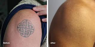 Certified tattoo artists begin working after chalking out a strategy to place the new design and color cautiously on the previous tattoo. Shoulder Tattoo Removal Results Case Study Removery