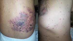 generalized vesicular skin lesions