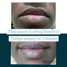 cosmetologist for mini punch grafting