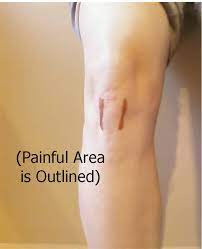 physio burlington knee pain