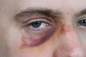 how to care for a black eye howtowise