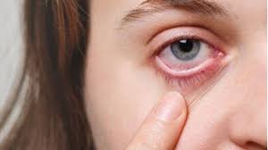 eye allergy itchy eyes symptoms causes