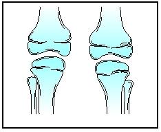 nail patella syndrome symptoms