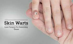 wart removal tips advice from top