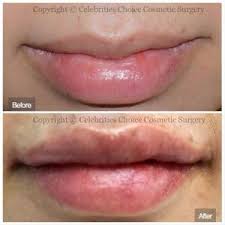 lip augmentation the many things we