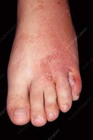 fungal infection and eczema of the foot