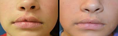 cleft lip nose deformity in india