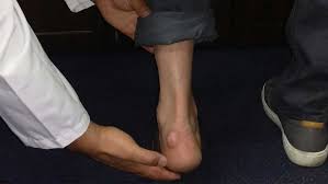 If you think you may have hurt your achilles, see a doctor straight away. Painful Bump On The Back Of Your Heel