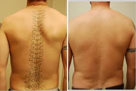 tattoo removal faq rl center