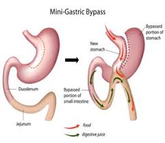 gastric byp london obesity centre