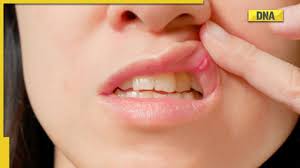 mouth ulcer a sign of serious health