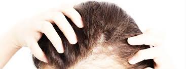 Patterns of baldness for both men and women are different, but the cause for this hair loss condition is genetic. Female Pattern Baldness Symptoms Causes Natural Remedy Hairstyle