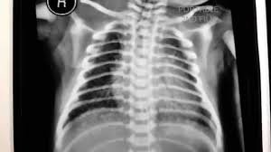 Transient tachypnea of the newborn. Rds Respiratory Distress Syndrome Chest X Ray Youtube