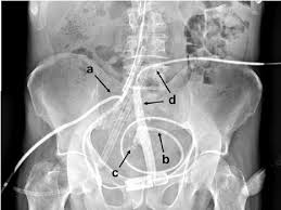 Pancreaticocutaneous Fistula Shunting Procedure A Jackson