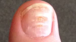 psoriatic arthritis nail changes