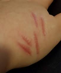 scars trying out rigid collodion