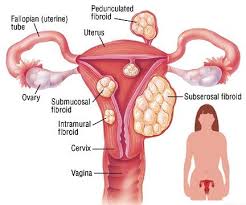 fibroids guide causes symptoms and