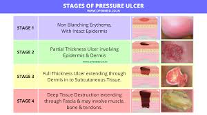 ses of pressure ulcer
