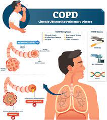 This animation describes the causes, risk factors and common symptoms of chronic obstructive pulmonary disease (copd), as well as how lungs with copd. Chronic Obstructive Pulmonary Disease Copd Springerlink