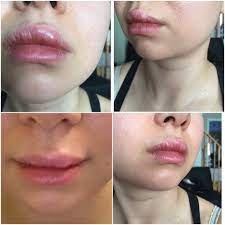 lip injection lumps normal or not