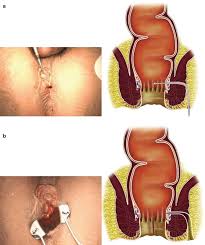 anorectal abscess and fistula
