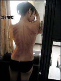 Biasanya, orang membalur bagian punggung penderita masuk angin. Kerokan Kerikan Gua Sha Masuk Angin Cao Gio Kerokan K Flickr