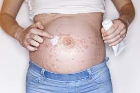 pregnancy rash 7 types appearance