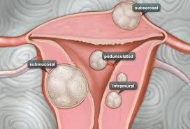 A Visual Guide To Uterine Fibroids