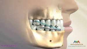 Braces are the easiest and most common way to correct an overbite. Orthodontic Treatment For Underbite Or Crossbite Carriere Appliance Youtube