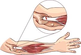 Tennis Elbow - Causes and Treatment | familydoctor.org