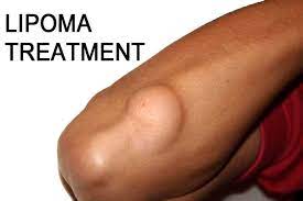 lipoma treatment क य आपक शर र म