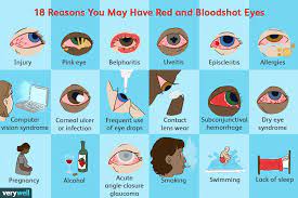 bloodshot eyes 20 reasons why eyes are red