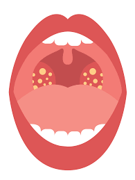 what are tonsil stones symptoms