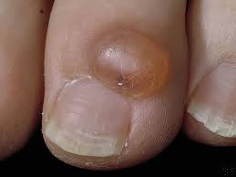 myxoid cyst drainage causes and