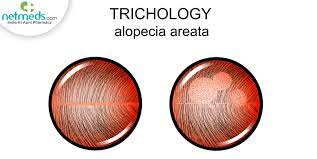 alopecia areata effective home