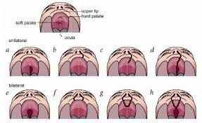 cleft lip cleft palate clification