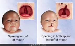 with cleft lip and palate