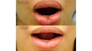 lip reduction surgical procedure side