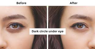 how to remove dark circle under the eye