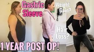 gastric sleeve surgery 1 year post op