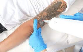 tattoo removal creams a guide for
